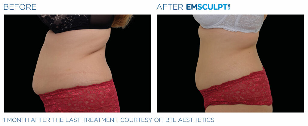 The sideview of a womans stomach before and after treatment.