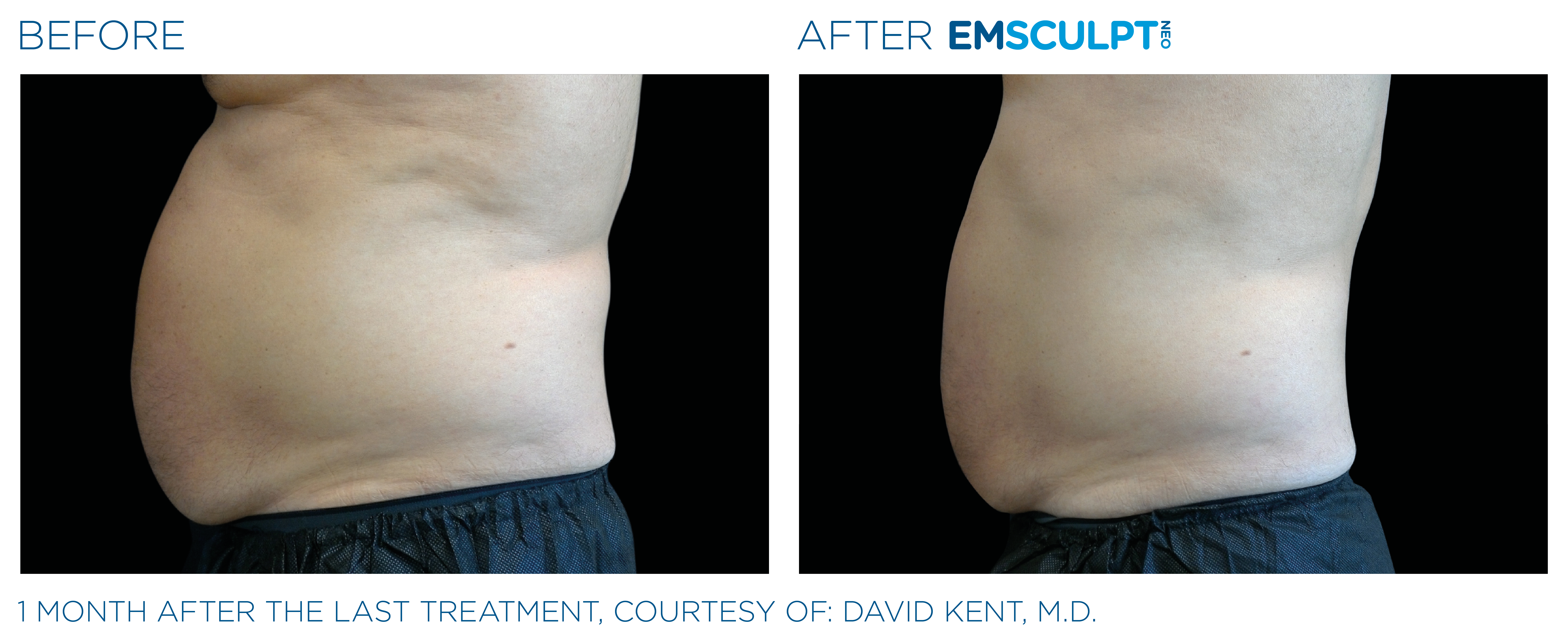 The sideview of a mans stomach before and after treatment.
