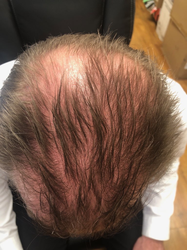 Top of a person's head after hair treatment