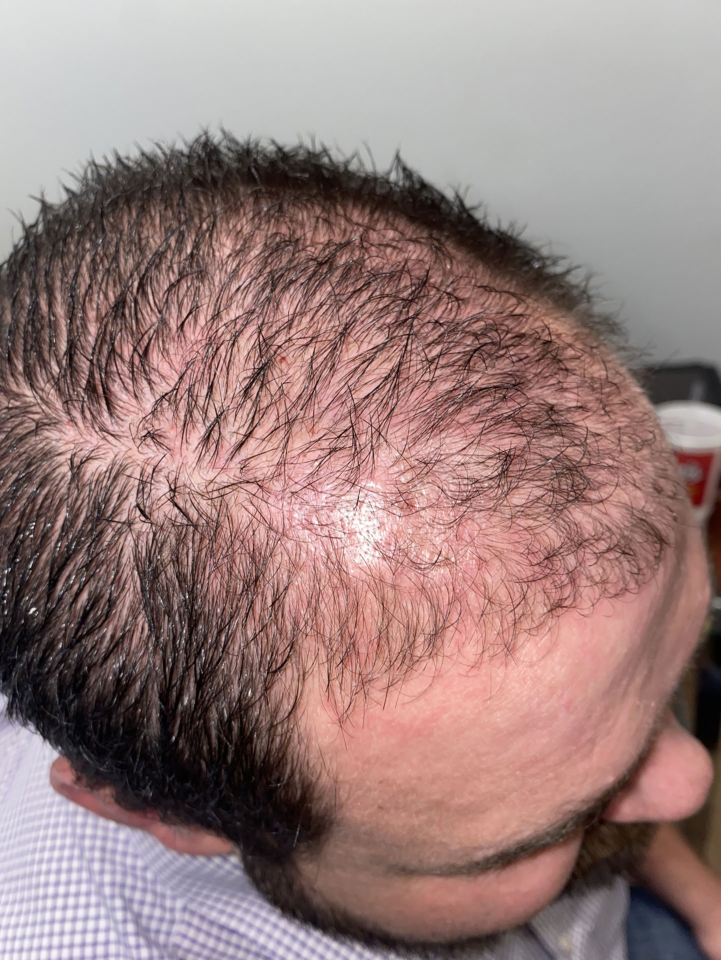 Top of a person's head before hair treatment
